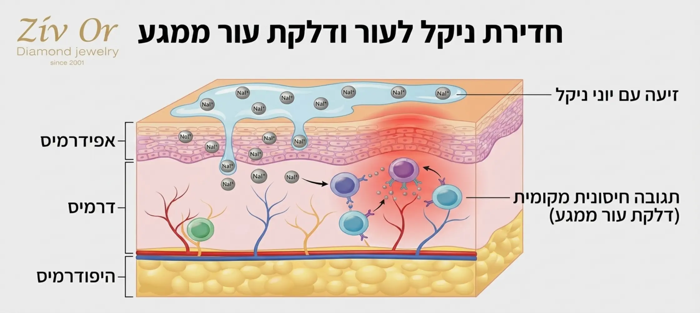 אינפוגרפיקה המציגה את שכבות העור ואת האופן שבו חלקיקי ניקל מתמוססים בזיעה חודרים את השכבה העליונה וגורמים לתגובה חיסונית מקומית המוכרת כדלקת עור ממגע